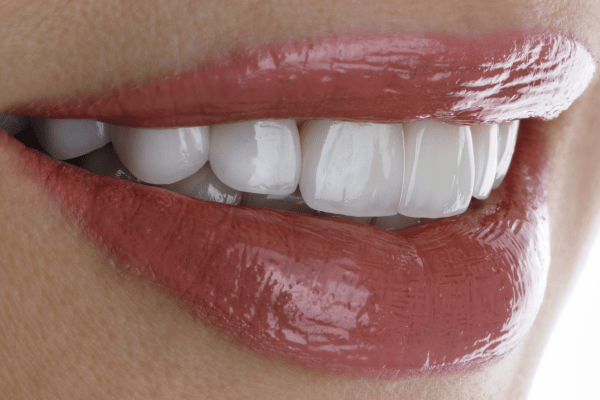 מה זה ציפוי חרסינה לשיניים ואיפה יש מרפאת שיניים בתל אביב